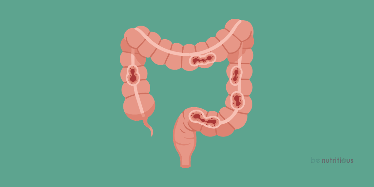 Εκκολπώματα διατροφή